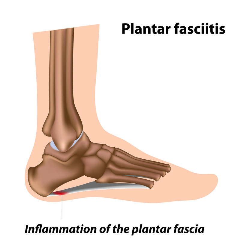 plantar fasciitis
