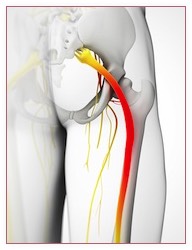 Sciatica Occurs From Irritation of the Sciatic Nerve