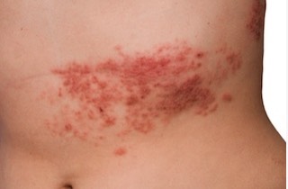 Shingles Appears as a Painful Rash
